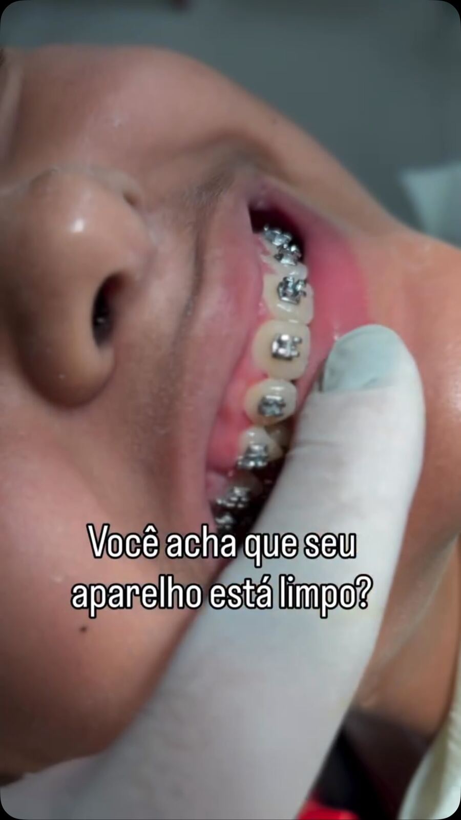 Higiene do aparelho