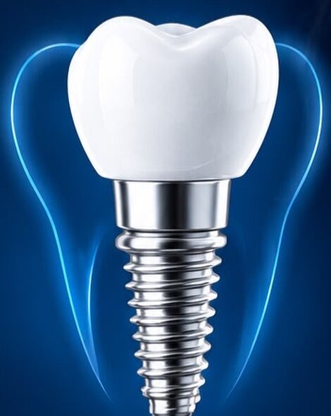 Implante dentário