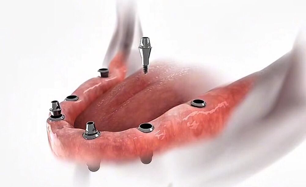 Componentes sobre os implantes