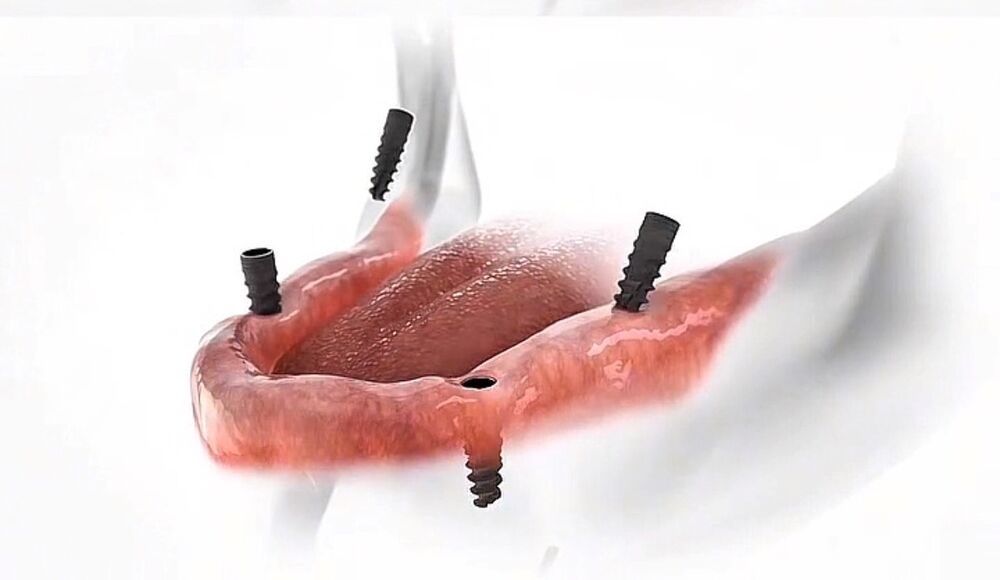 Implantes instalados