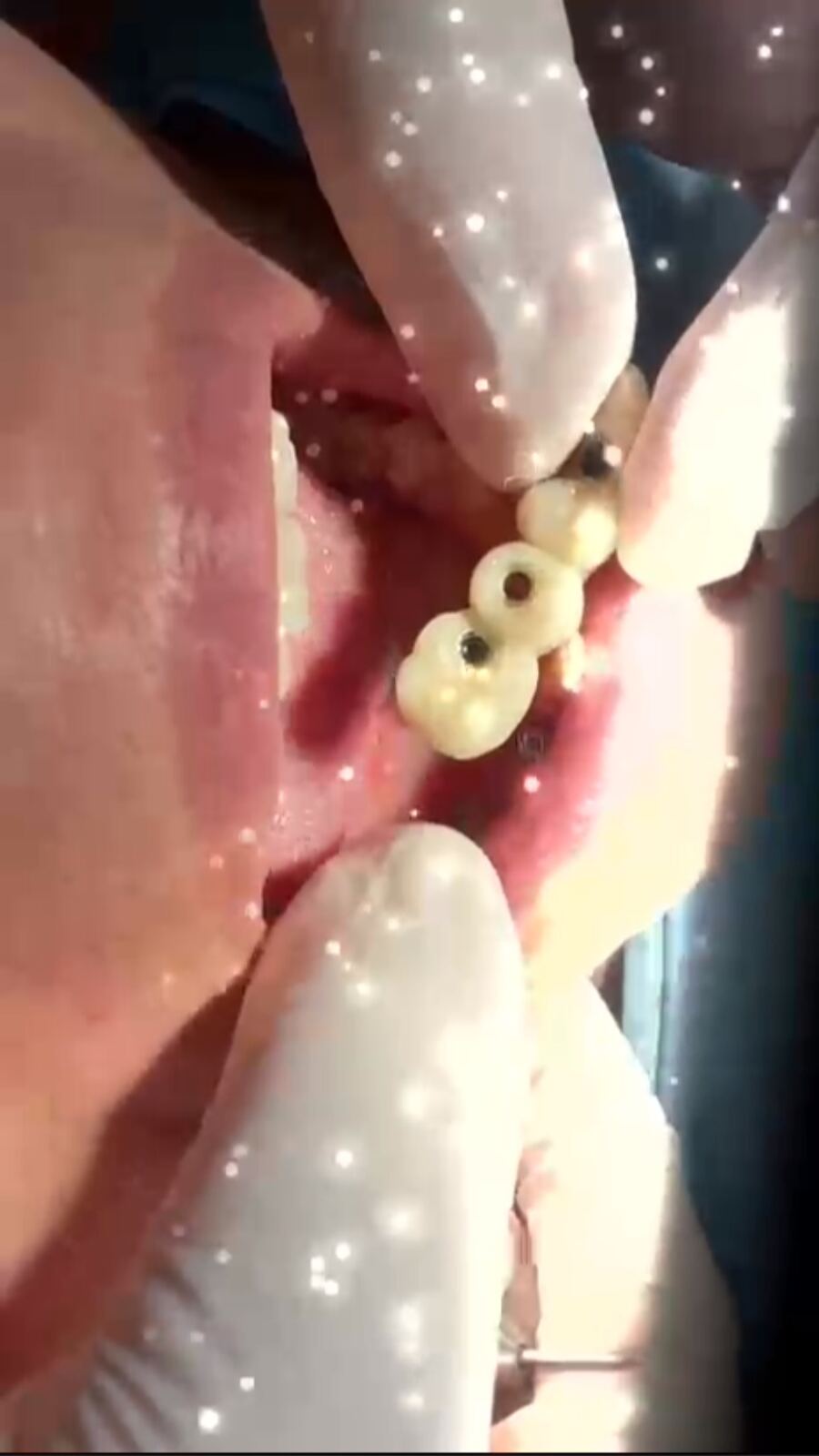 Implantes com componentes